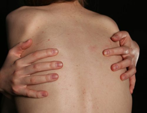Vax-Induced Shingles